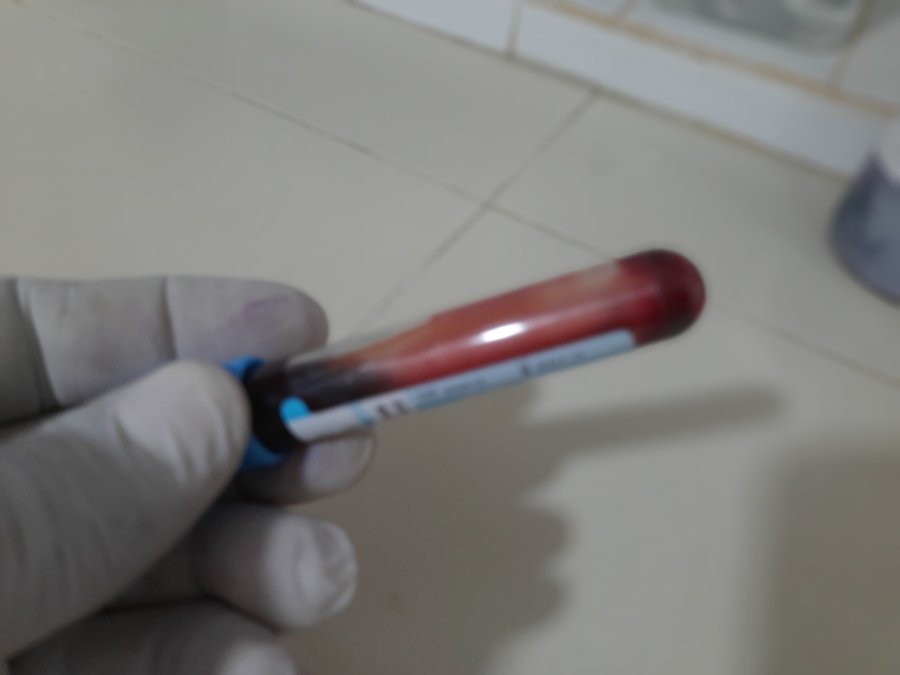 Étapes de l'hémostase