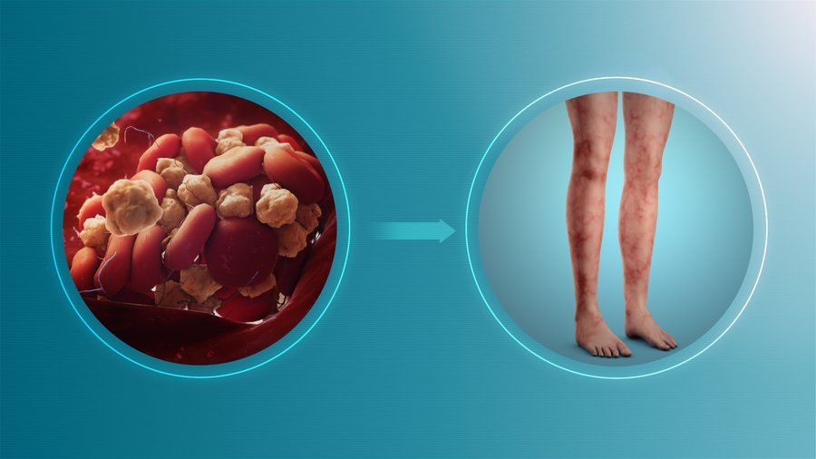 Syndrome des antiphospholipides