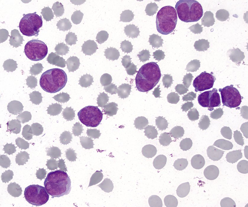 Promyélocytes anormaux au frottis