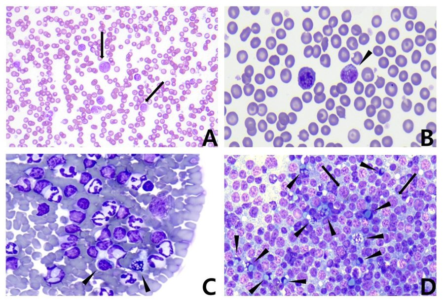 Lymphoblastes au frottis