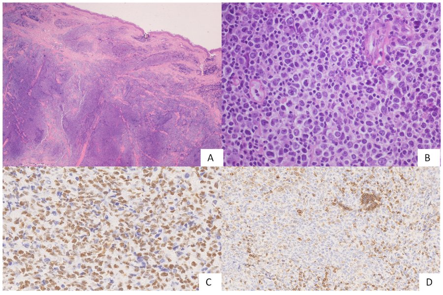 Lymphome agressif à croissance rapide