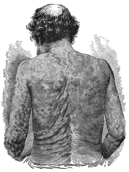 Atteinte cutanée des lymphomes T