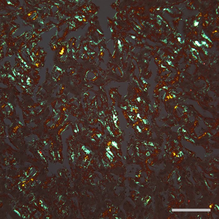 Autres gammapathies monoclonales