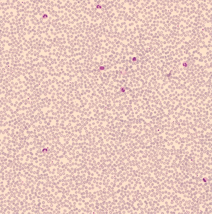 Anomalies morphologiques au frottis