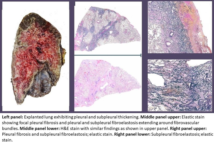Fibrose médullaire à la biopsie