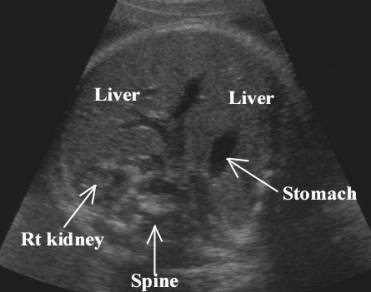 Palpation d'une splénomégalie