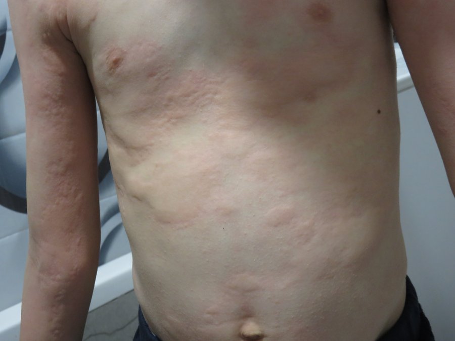 Réaction fébrile et allergique