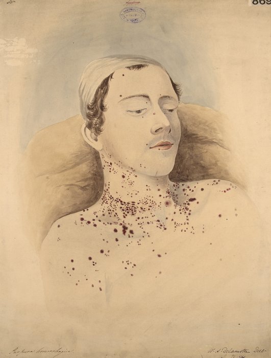 Purpura hémorragique diffus