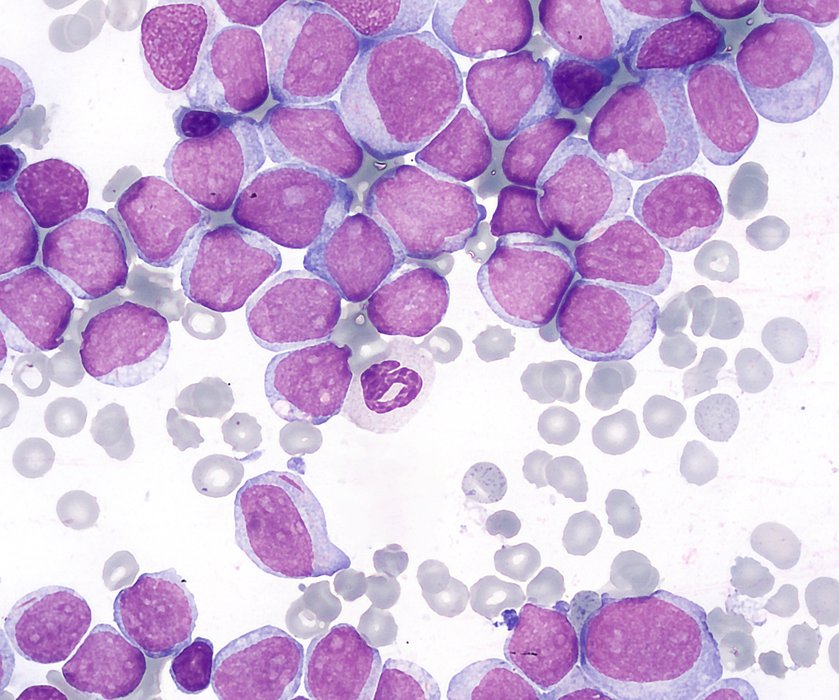 Hyperleucocytose blastique
