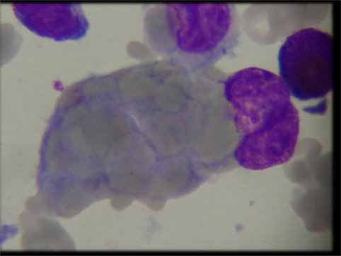Hémophagocytose médullaire