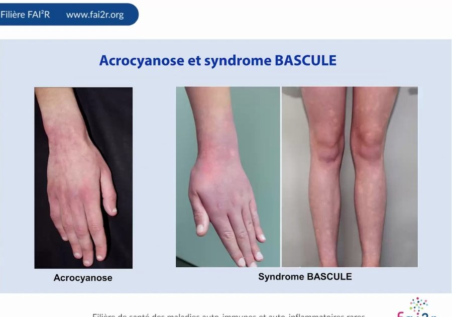 Acrocyanose de la main et lésions érythémateuses réticulées de la main et des jambes dans le syndrome BASCULE