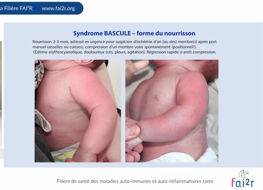 Œdème érythrocyanotique du bras chez un nourrisson après portage