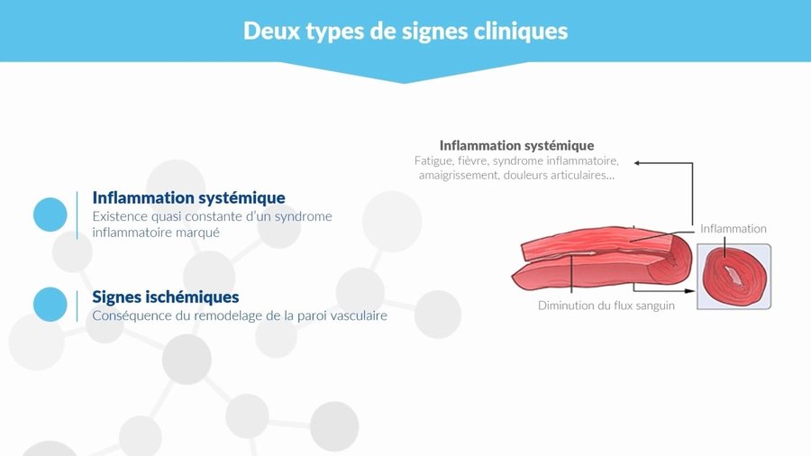Mécanisme de l'inflammation vasculaire : inflammation systémique et diminution du flux sanguin par remodelage pariétal