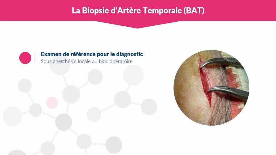 Biopsie chirurgicale de l'artère temporale sous anesthésie locale