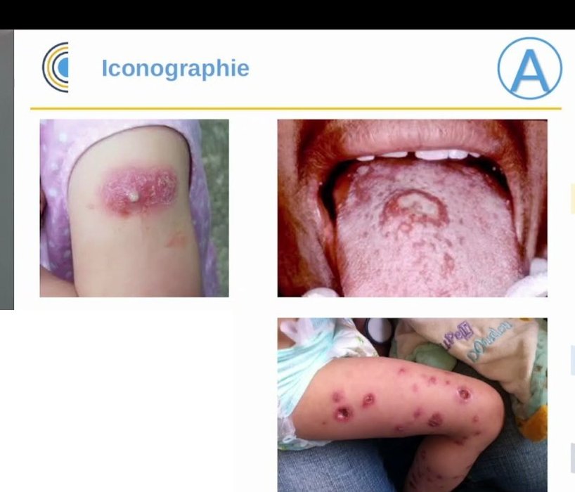 Lésion cutanée abcédée du bras, candidose buccale et lésions cutanées vésiculo-pustuleuses de la jambe chez l'enfant