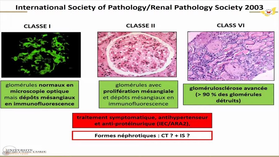 Classification ISN/RPS 2003 des glomérulonéphrites lupiques : classe I, II et VI