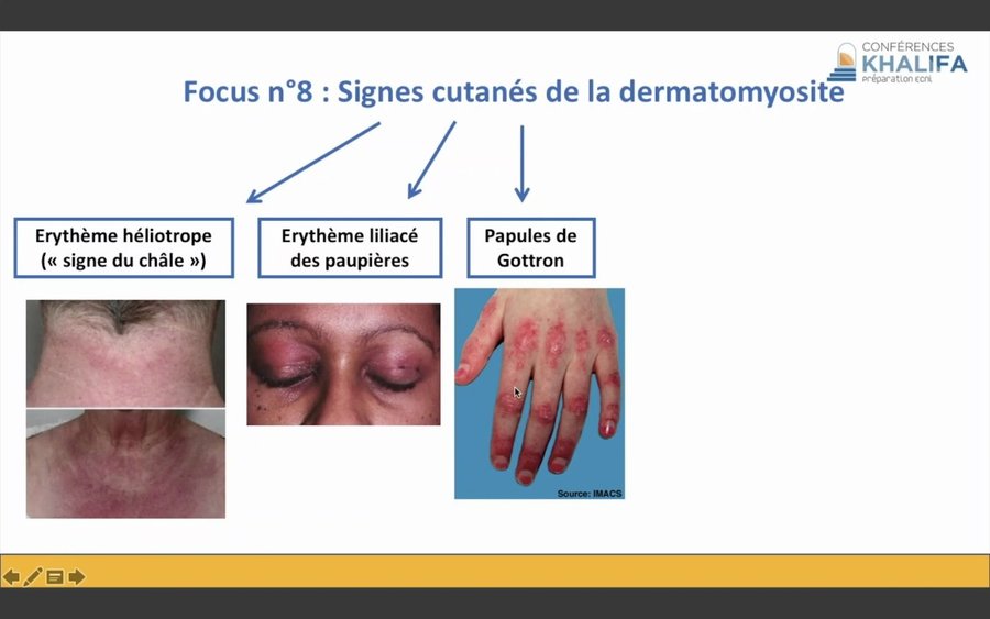 Signe du châle, érythème liliacé des paupières et papules de Gottron