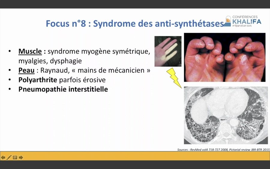 Phénomène de Raynaud, mains de mécanicien et pneumopathie interstitielle au scanner