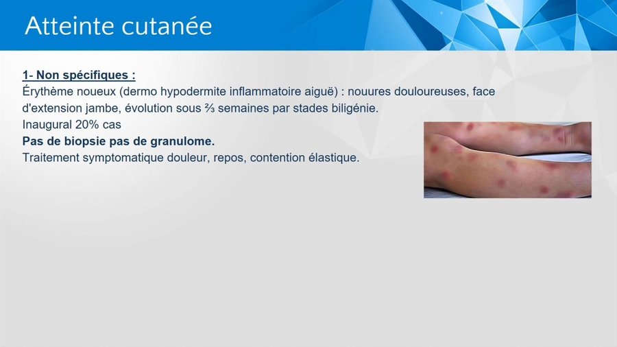 Érythème noueux des jambes