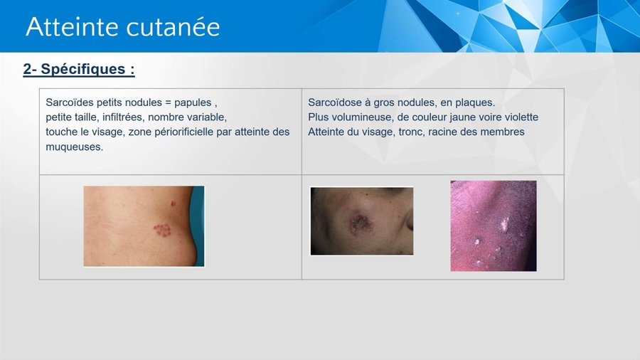 Sarcoïdes papuleuses et sarcoïdose à gros nodules en plaques