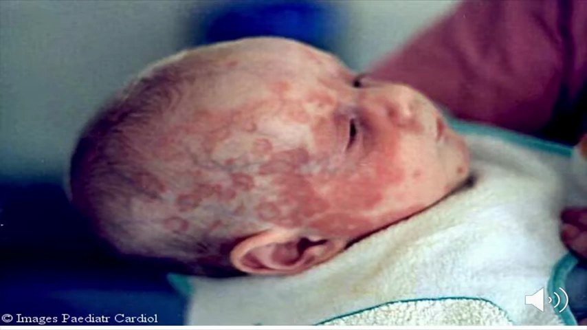 Éruption cutanée annulaire du lupus néonatal sur le cuir chevelu et le visage d'un nouveau-né