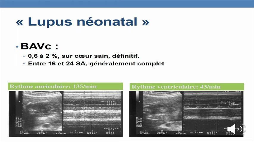 Échographie fœtale montrant un bloc auriculo-ventriculaire congénital complet