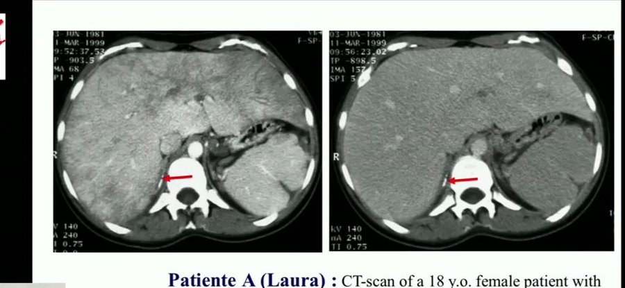 Scanner abdominal montrant une atteinte hépatique et une calcification surrénalienne chez une patiente atteinte de CAPS