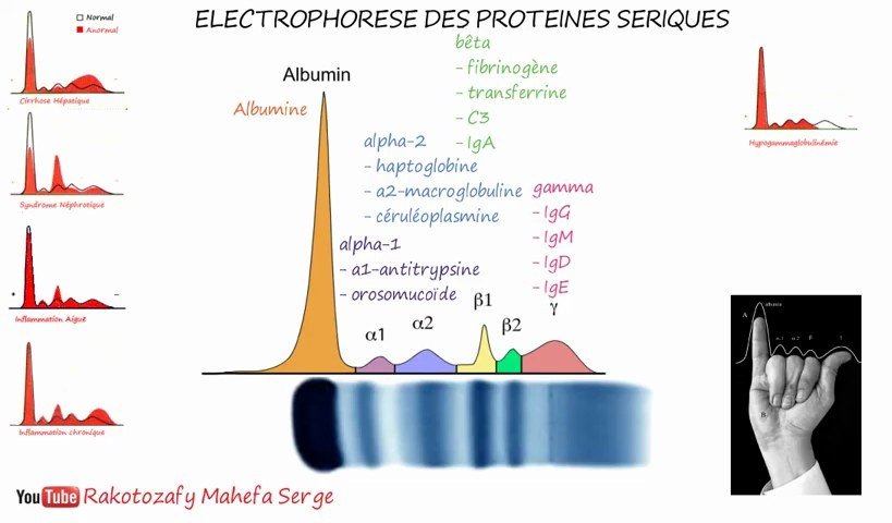 Profil normal de l'électrophorèse des protéines sériques et profils pathologiques types