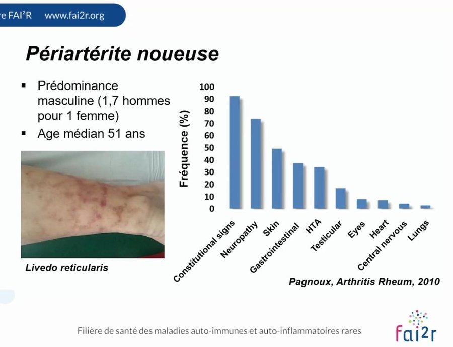 Livedo reticularis de la jambe et fréquence des atteintes d'organes dans la PAN