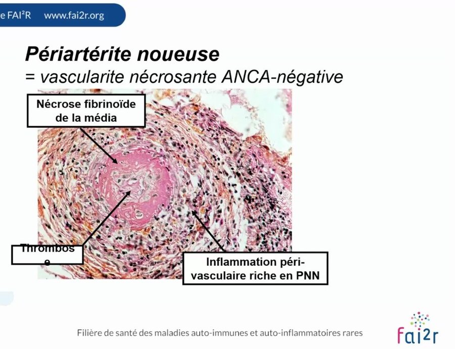 Histologie d'une artère de moyen calibre montrant nécrose fibrinoïde, thrombose et infiltrat inflammatoire