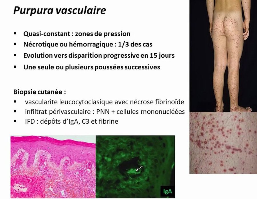 Purpura vasculaire nécrotique des jambes avec histologie et immunofluorescence à dépôts d'IgA