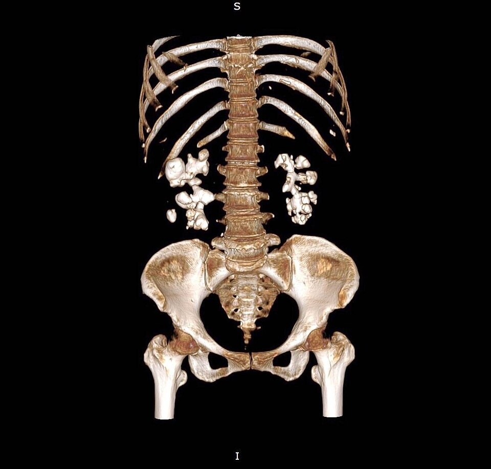 Uroscanner — calcul urinaire