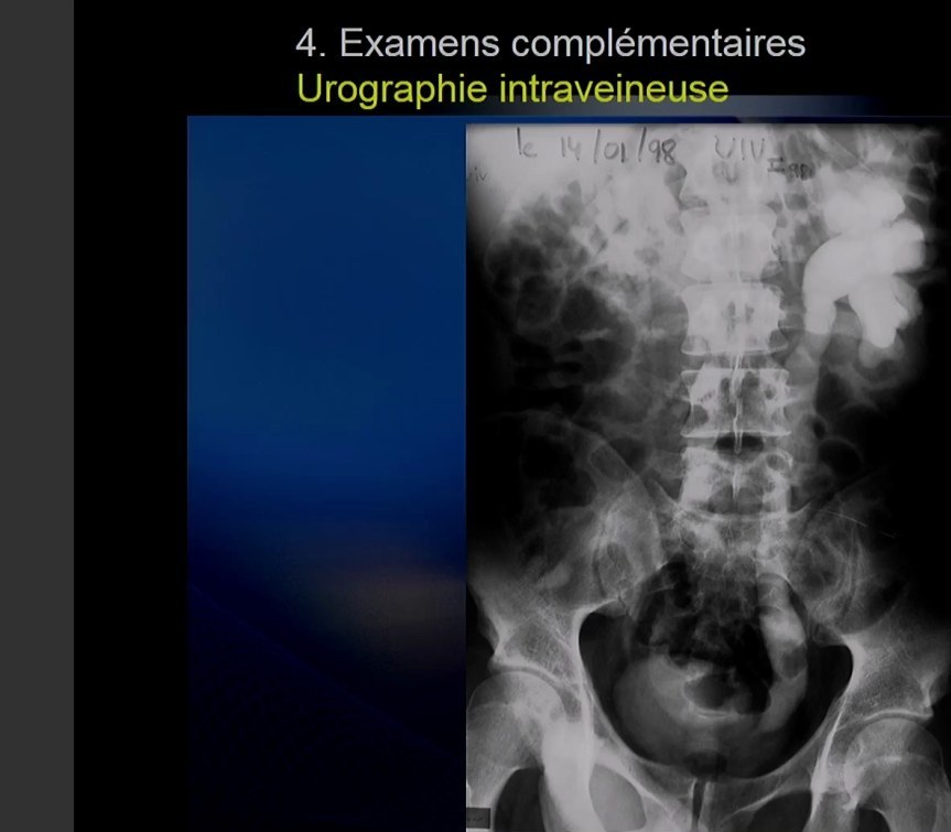 Infection Urinaire de l'Enfant