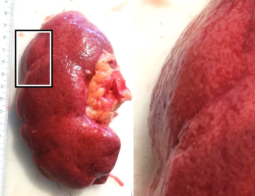 Néphroangiosclérose — surface rénale granuleuse