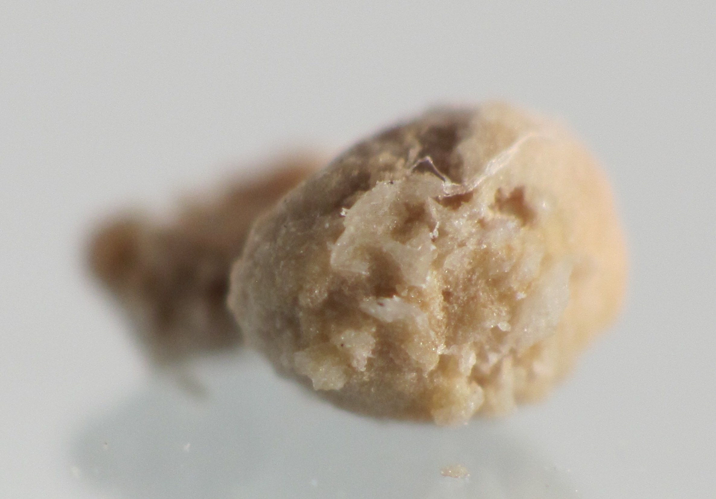 Calcul rénal (lithiase oxalo-calcique)