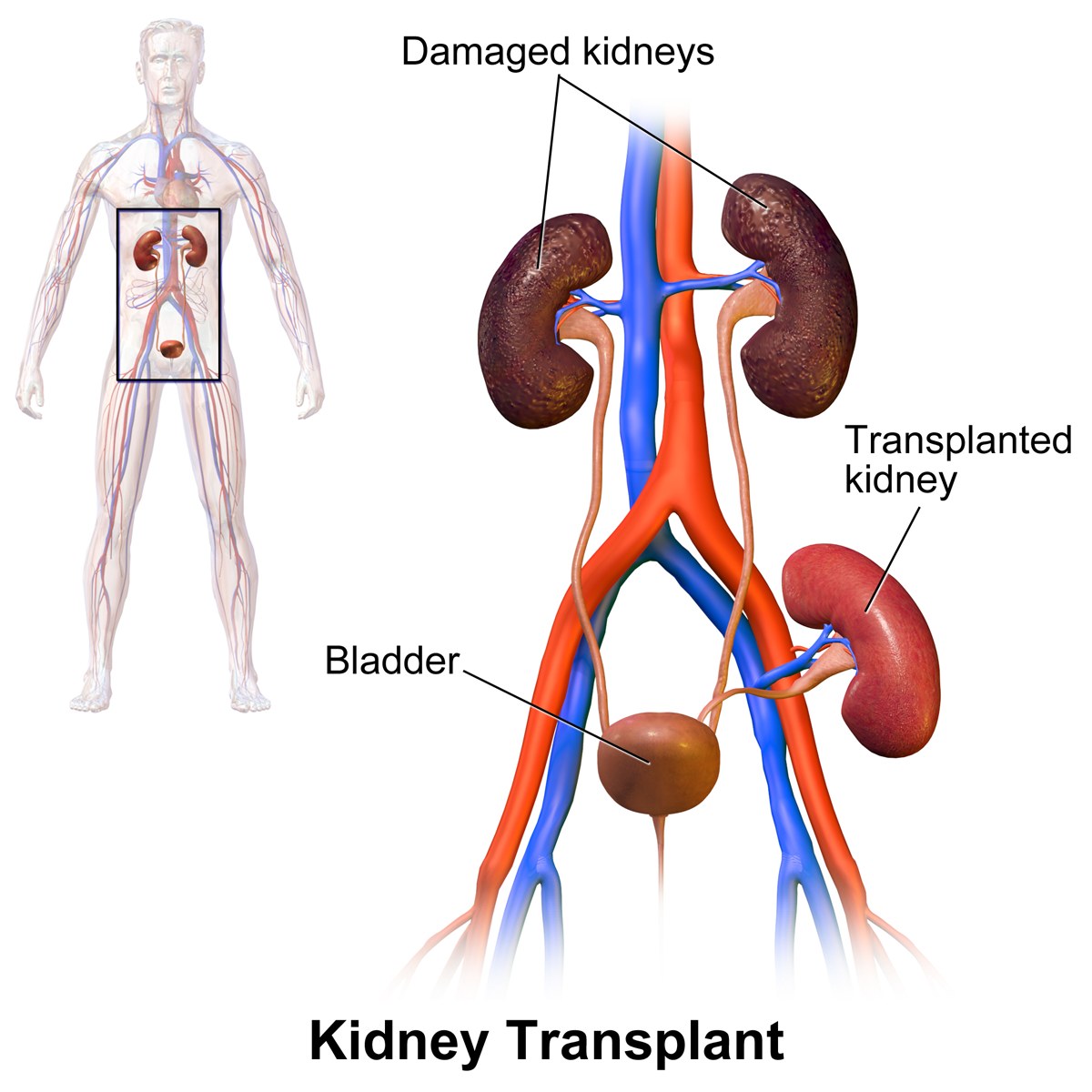 Chirurgie de transplantation rénale
