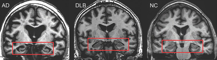 Maladie d'Alzheimer
