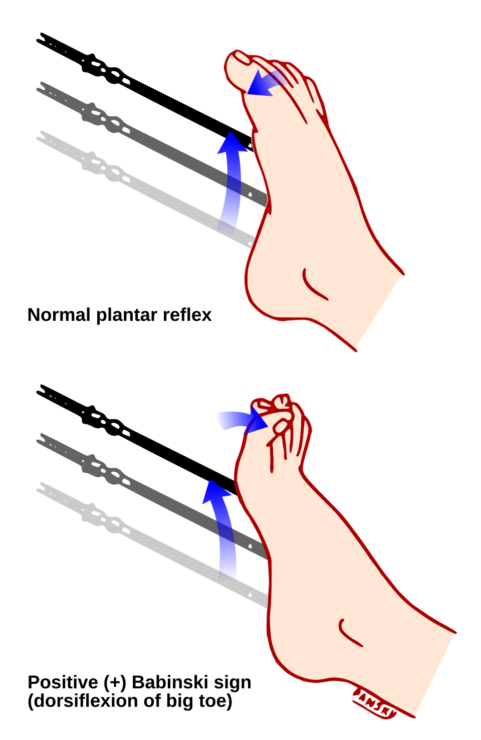 Signe de Babinski