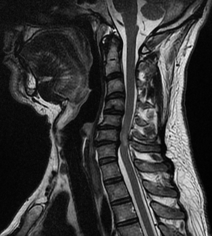 Compression médullaire