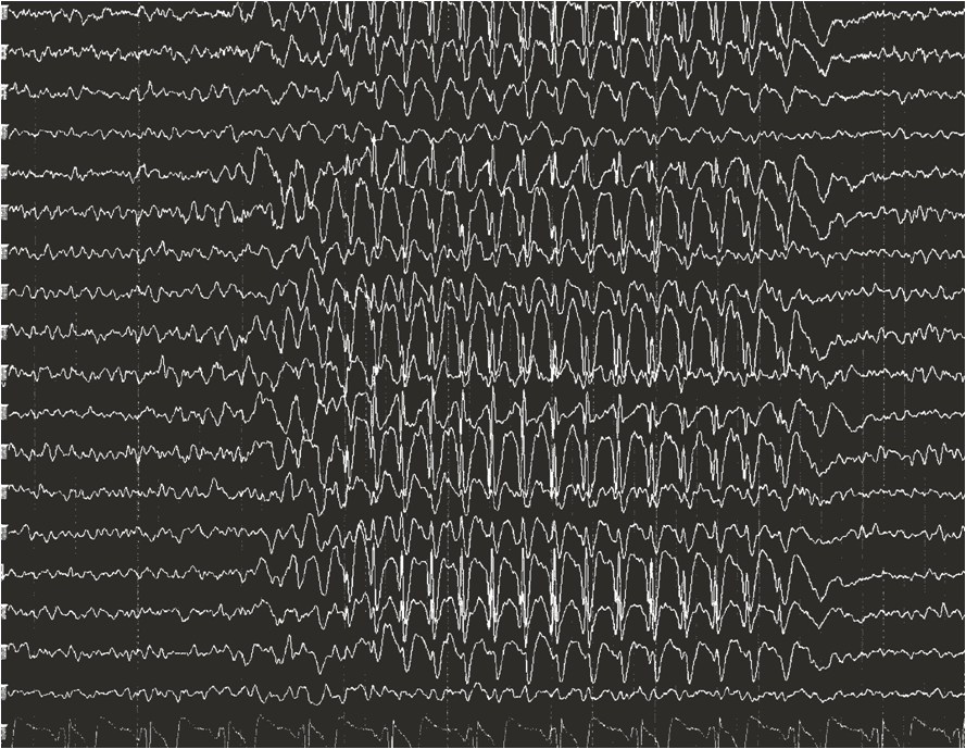 État de mal épileptique (EEG)