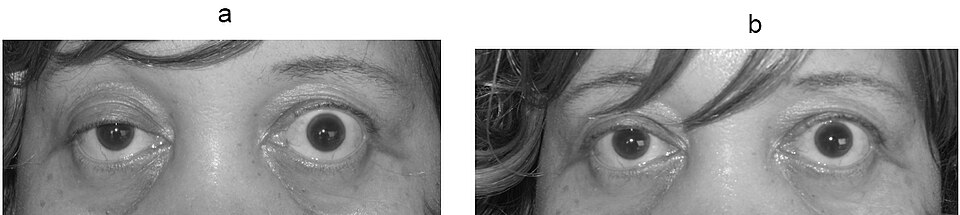 Myasthénie (ptosis)