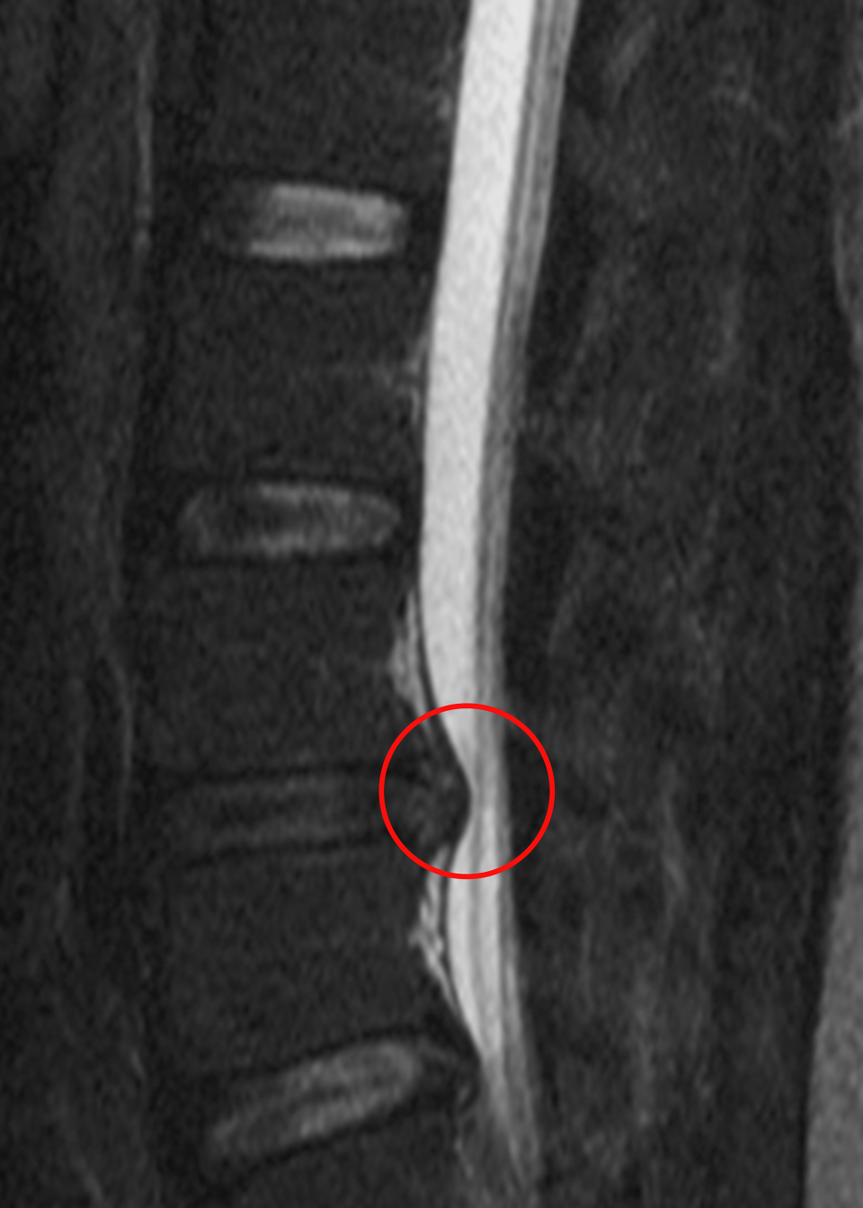 Sciatique / hernie discale