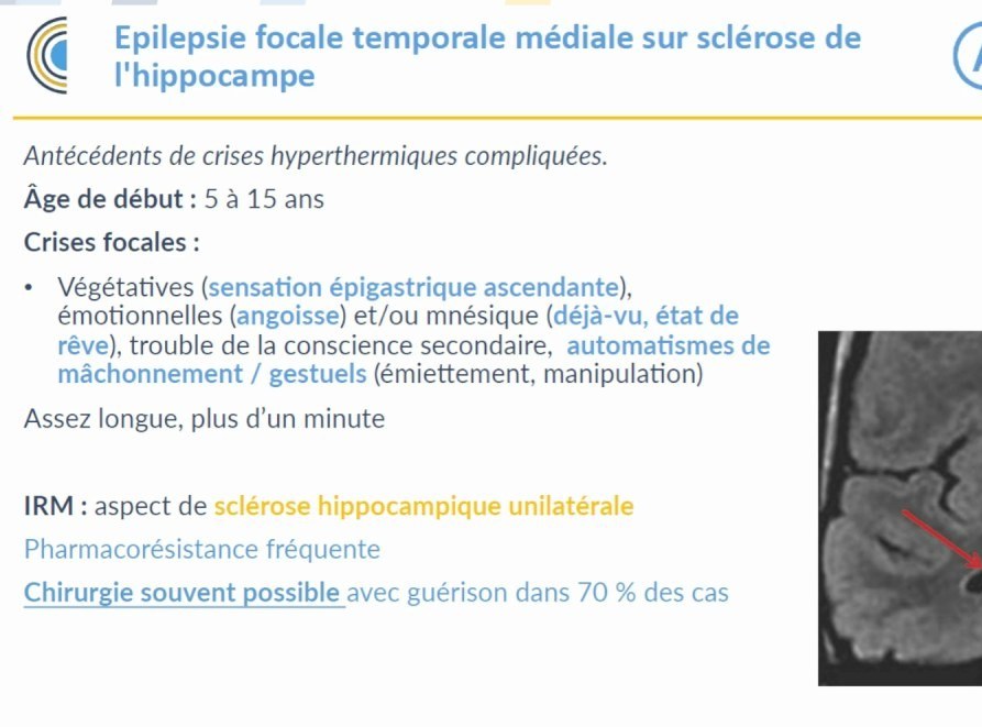 Épilepsie de l'Enfant et de l'Adulte
