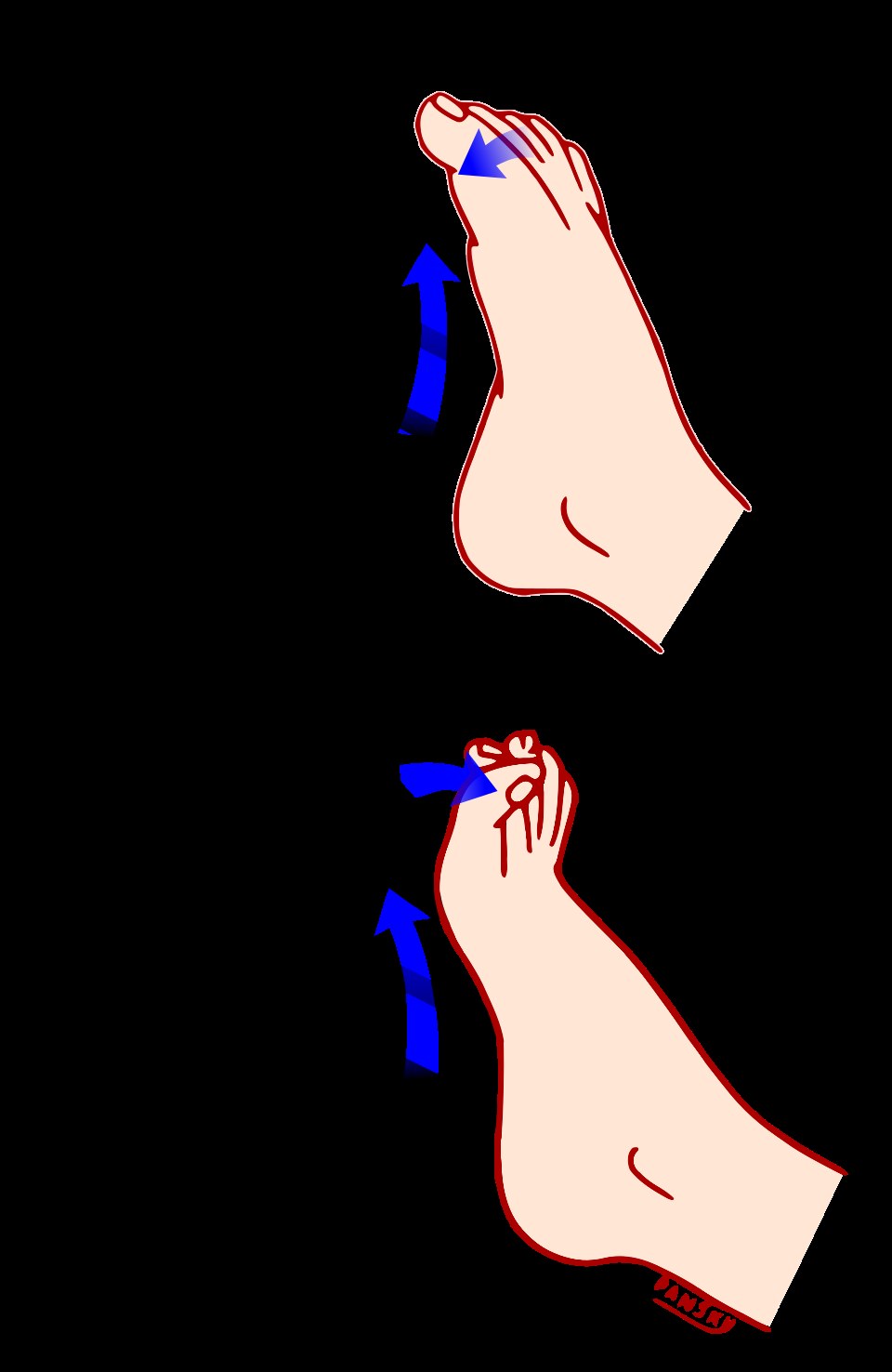 Stimulation plantaire (signe de Babinski)