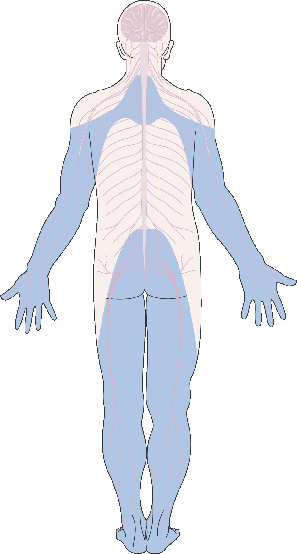 Schéma de la neuropathie périphérique