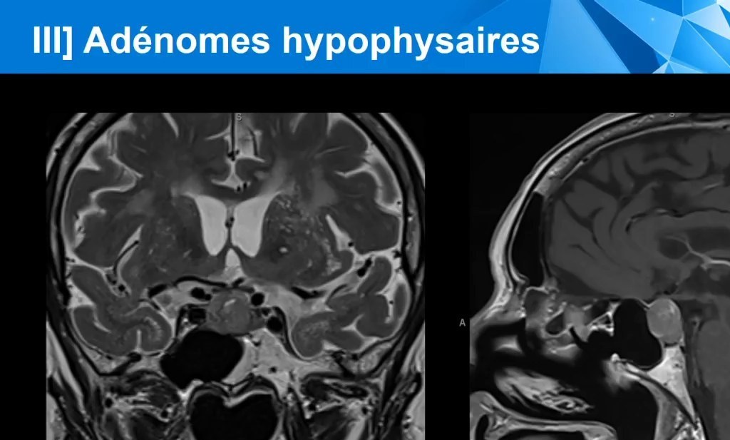 Tumeurs Intracrâniennes