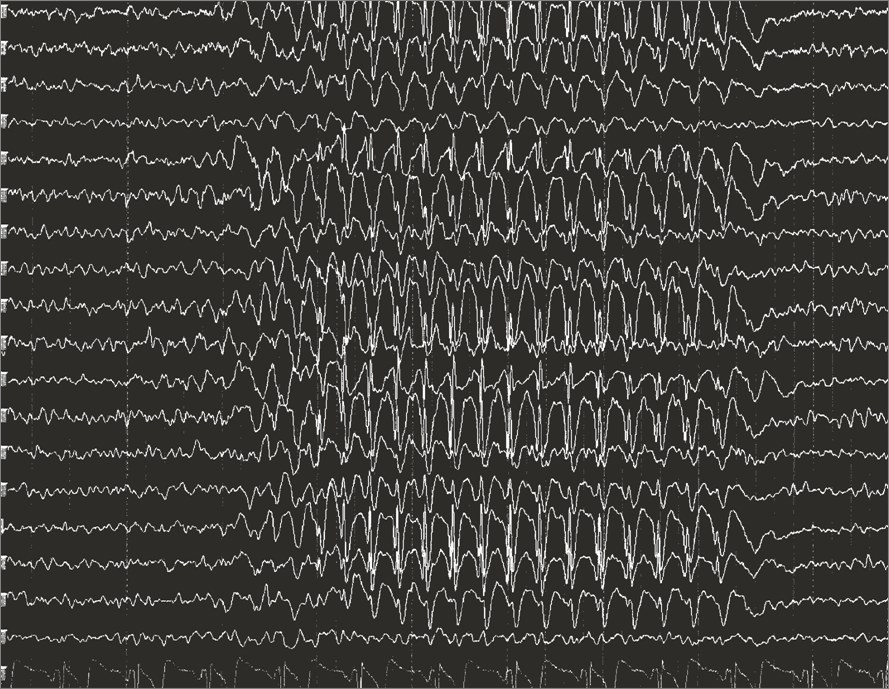 EEG — état de mal épileptique