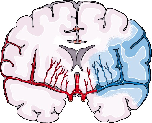 Schéma de la thrombectomie mécanique