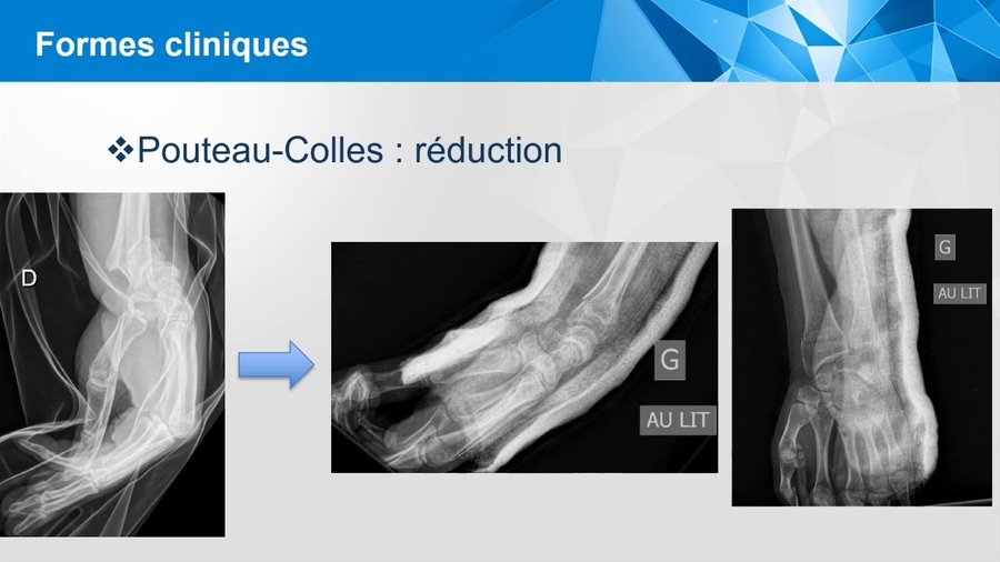 Atlas des différents types de fracture de l'extrémité inférieure du radius