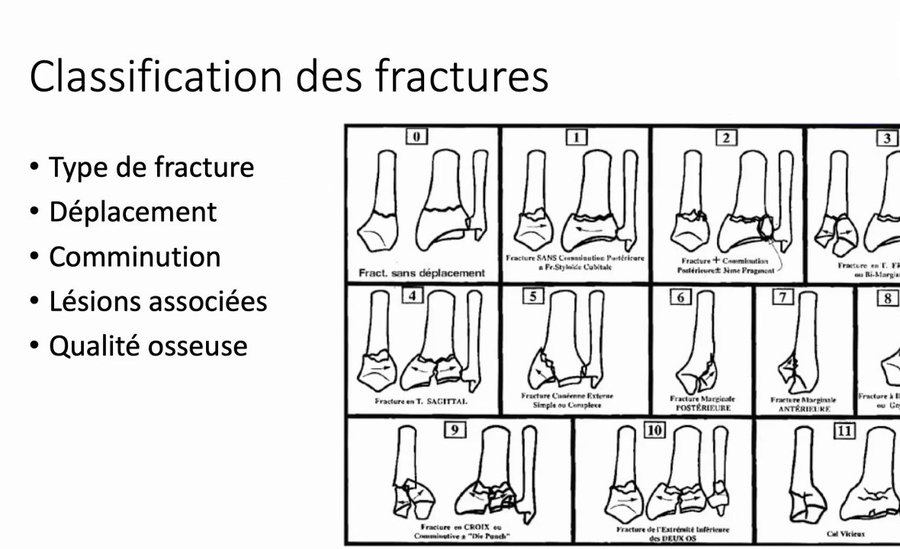 Radiographie montrant une fracture comminutive sévère de l'extrémité inférieure du radius
